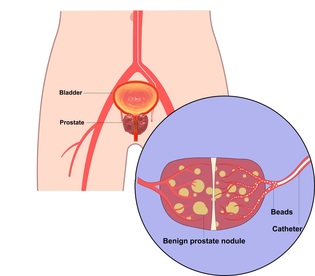 Prostate Artery Embolisation Virq