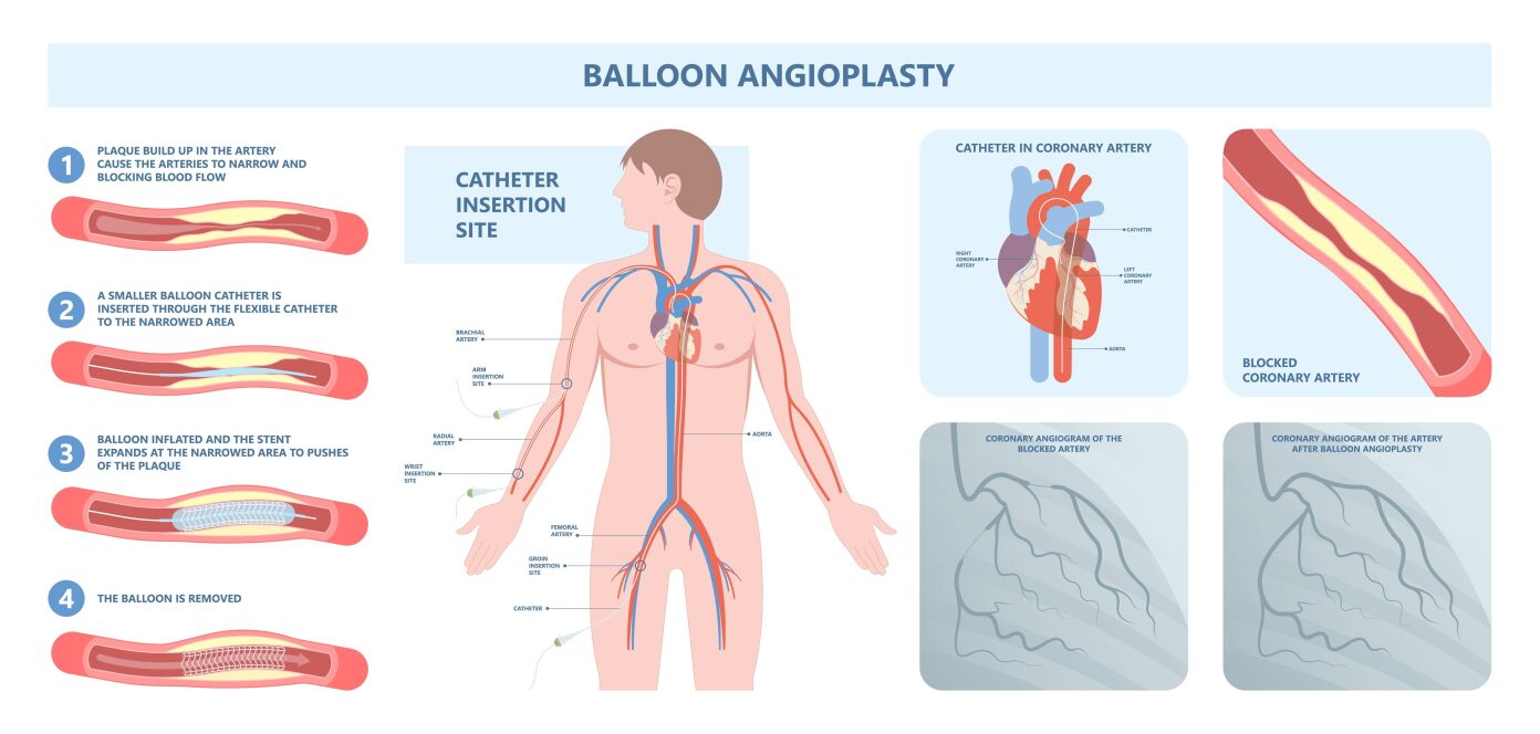 Angioplasty and Stenting diagram