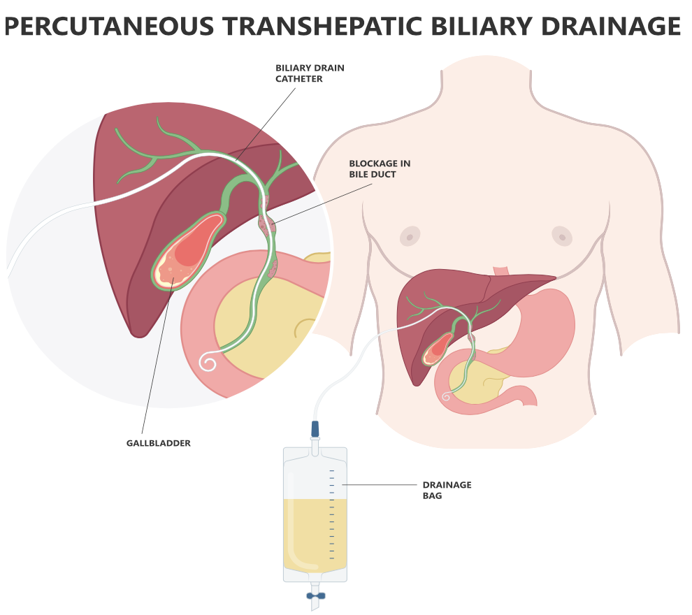 Hepatobiliary & Upper GI | Vascular & Interventional Radiology Qld