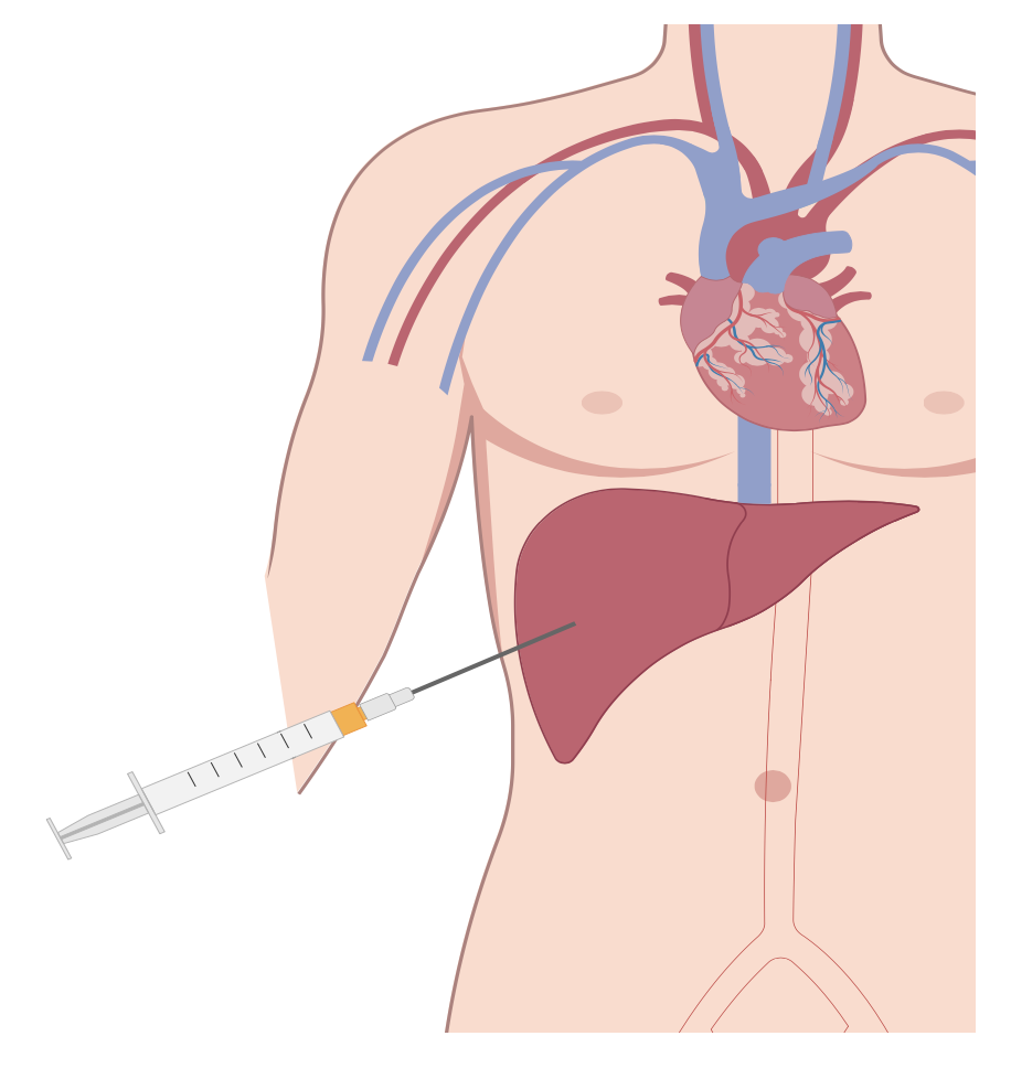 liver-biopsy-vascular-and-interventional-radiology-queensland