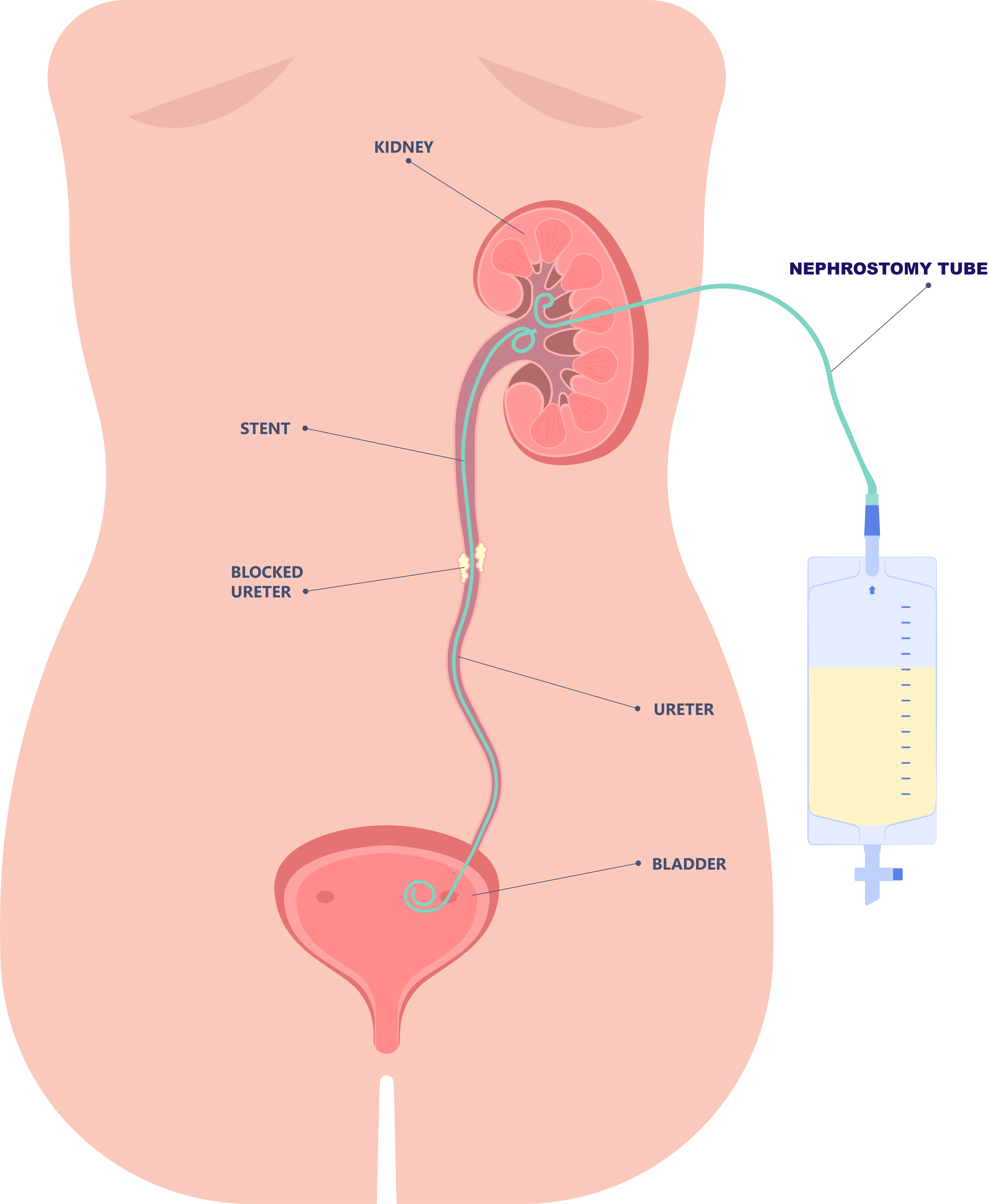 Ureteric stent insertion diagram