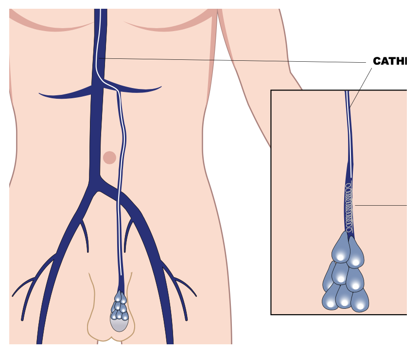 Diagram of varicocele embolisation