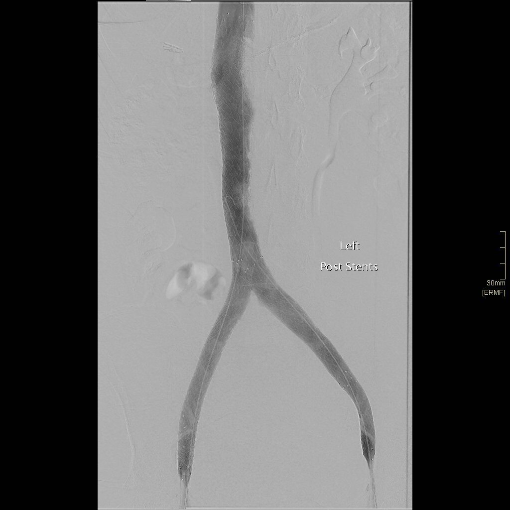 Venous Stent procedure