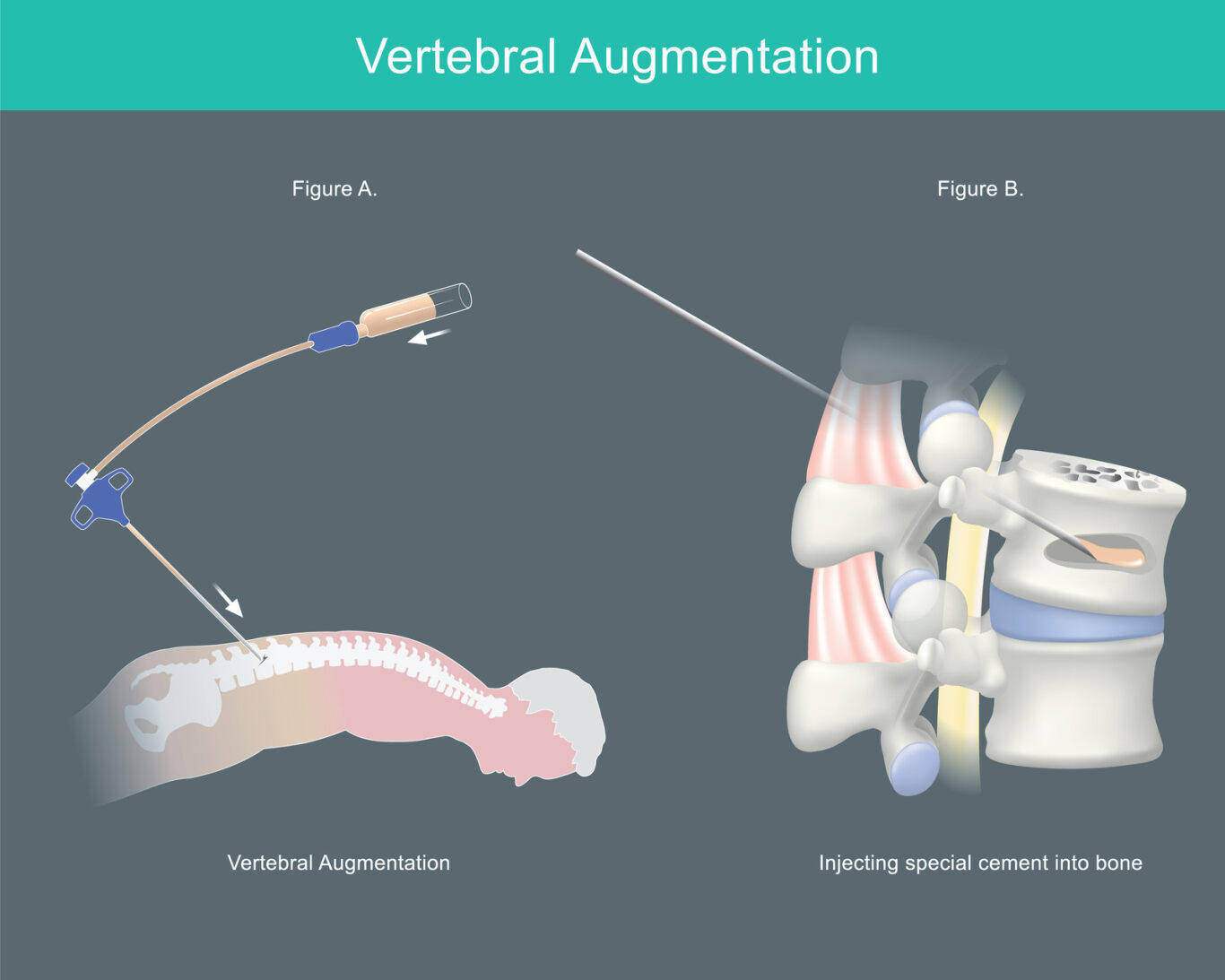 Vertebroplasty procedure diagram