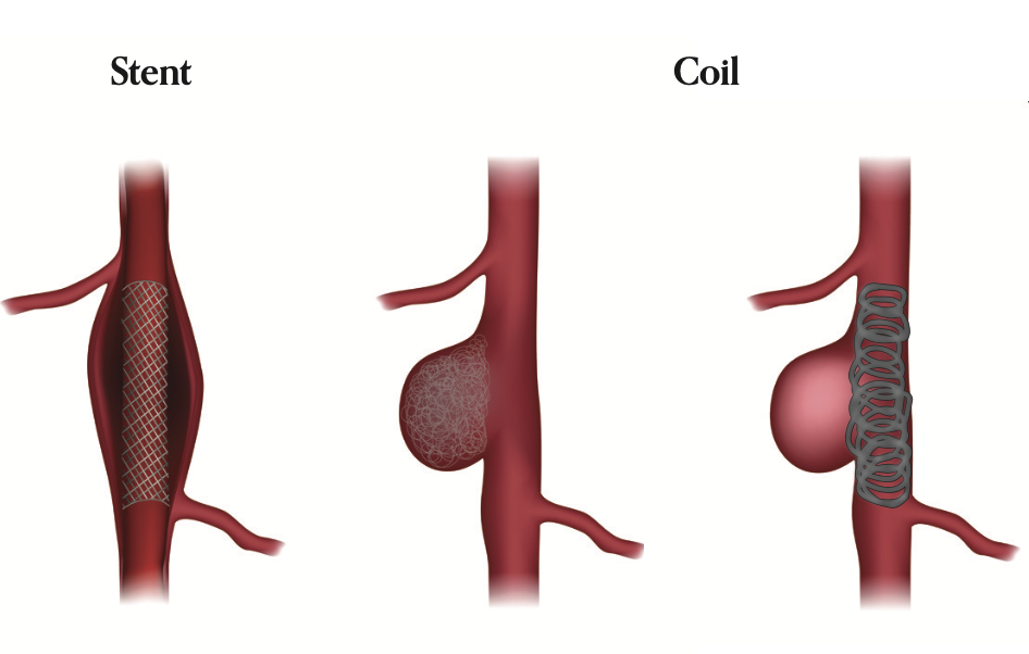 diagram of visceral aneurysm treatment